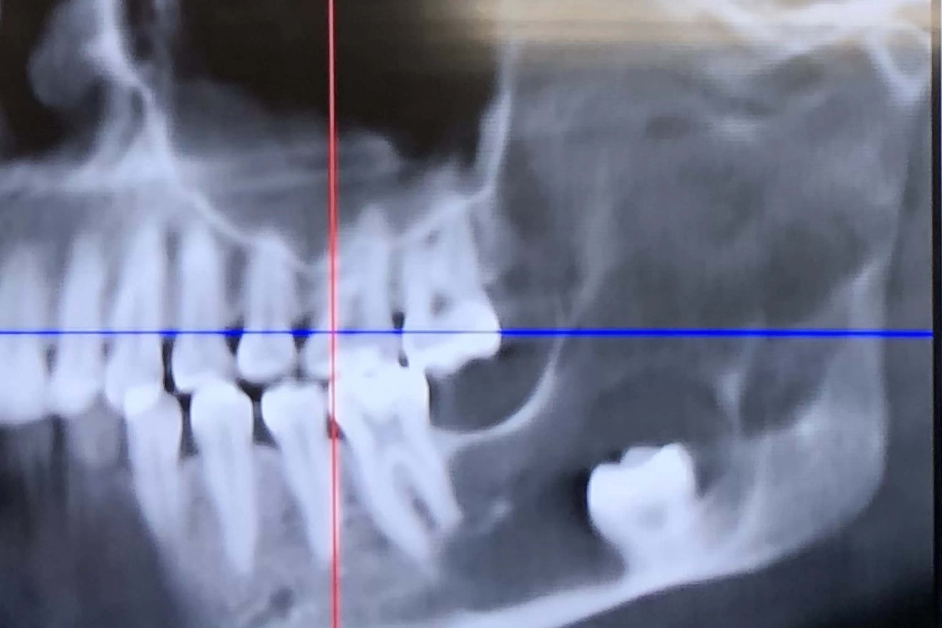 Woman Thinks She Needs Wisdom Tooth Removed—Surgeons Find Something Else