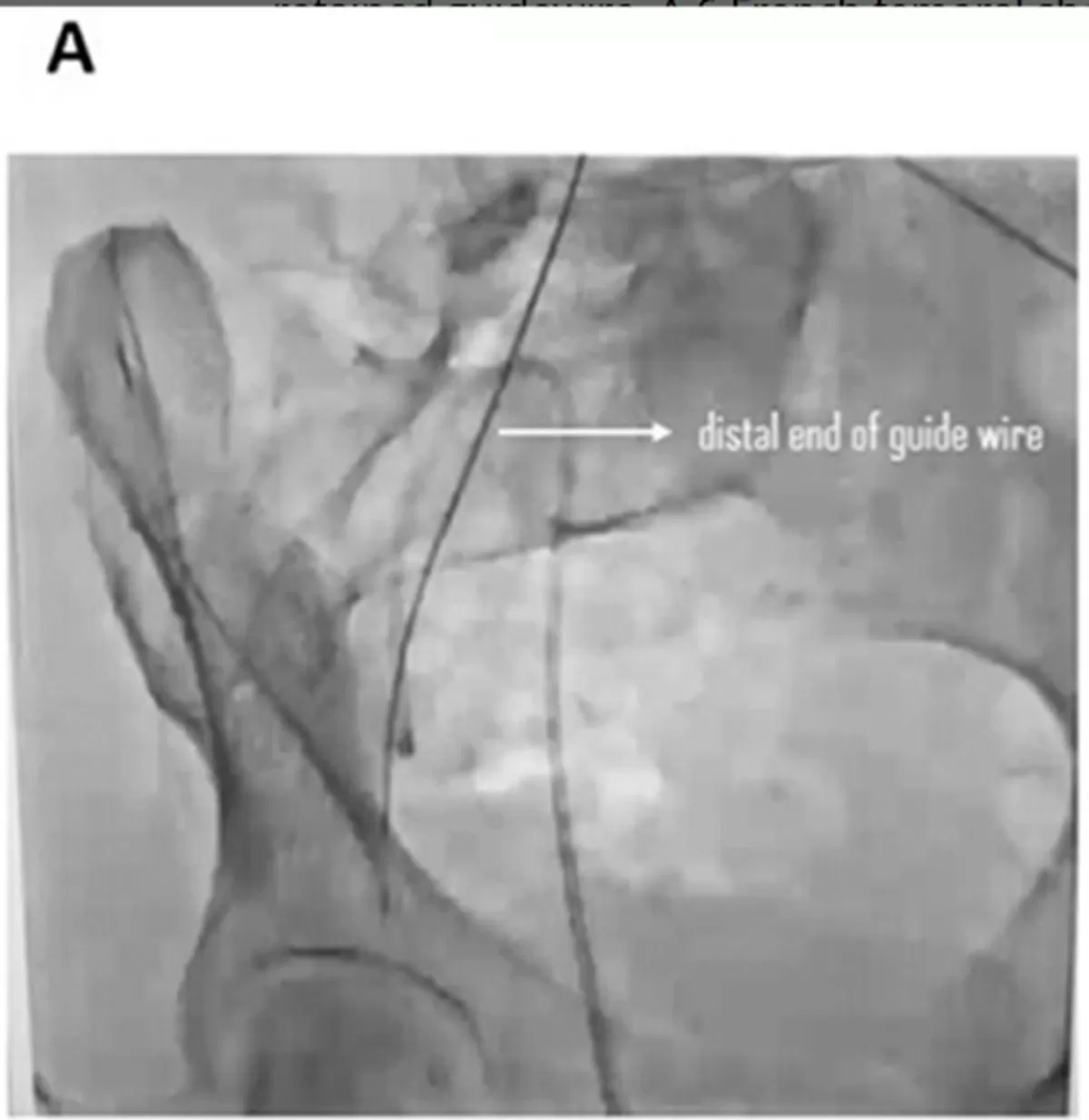 Woman Felt Fine Months After Procedure—X-Ray Reveals Object Left Inside Her